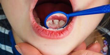 Έρευνα:To βούρτσισμα «ανεπαρκές» στη μάχη κατά της τερηδόνας