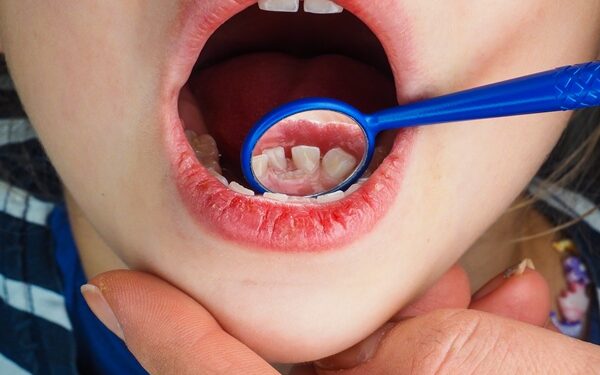 Έρευνα:To βούρτσισμα «ανεπαρκές» στη μάχη κατά της τερηδόνας