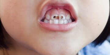 ΑCFF: Nα δείξουμε ότι η πρόληψη της τερηδόνας είναι η μόνη συμφέρουσα λύση για έναν κόσμο χωρίς τερηδόνα