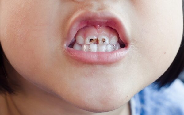 ΑCFF: Nα δείξουμε ότι η πρόληψη της τερηδόνας είναι η μόνη συμφέρουσα λύση για έναν κόσμο χωρίς τερηδόνα