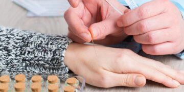 Ο βελονισμός μπορεί να χρησιμοποιηθεί ως μέσο καταπολέμησης του οδοντιατρικού άγχους