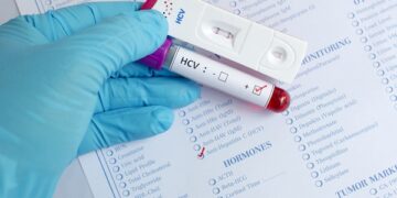 Έρευνα: Η ηπατίτιδα C αυξάνει τον κίνδυνο εμφάνισης καρκίνου του στόματος