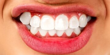 Έρευνα: Ο βρουξισμός έχει γενετική αιτιολογία