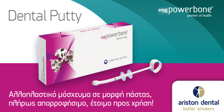 Powerbone Dental Putty – Αλλοπλαστικό μόσχευμα σε μορφή πάστας, έτοιμο προς χρήση!
