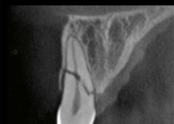 Cone Beam Computed Tomography in Endodontics