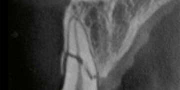 Cone Beam Computed Tomography in Endodontics