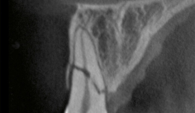 Cone Beam Computed Tomography in Endodontics