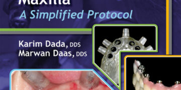 Esthetic Implant Restoration in the Edentulous Maxilla