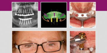Implantology Step by Step