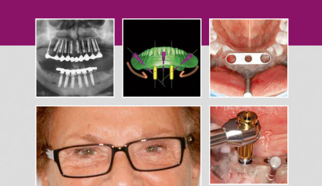 Implantology Step by Step