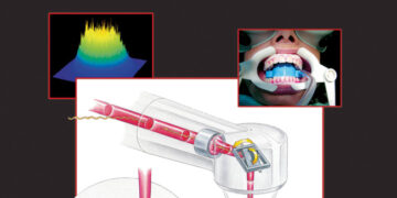 Oral Laser Application
