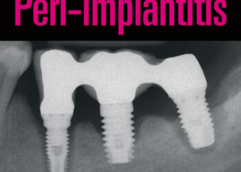Peri-implantitis