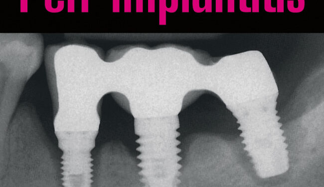 Peri-implantitis