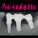 Peri-implantitis